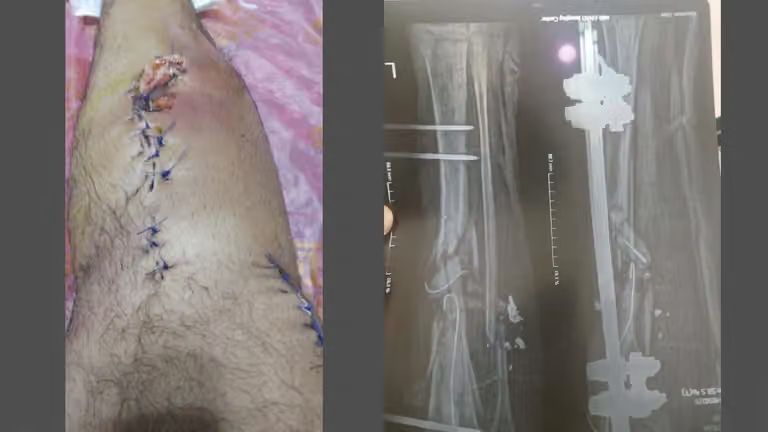A photo provided to Iran International shows the wounded protester’s surgically treated leg alongside an X-ray showing an external fixation device used during months of treatment after he was shot in Qazvin on January 8.