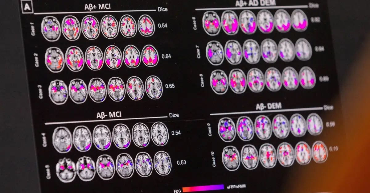 دانشمندان با تحریک سیستم لنفاوی مغز، موفق به بهبود حافظه موش‌های سالمند شدند