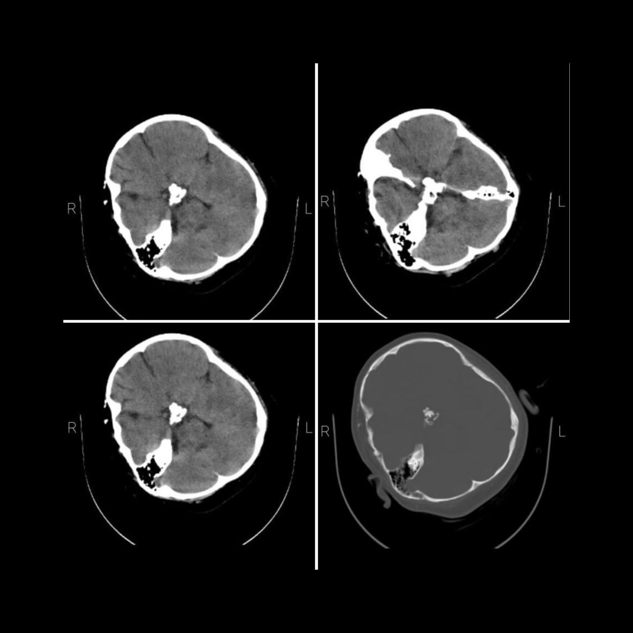 خاص لـ "إيران إنترناشيونال": الأشعة المقطعية لـ "مهسا أميني" تظهر كسرًا بالجمجمة ونزيفًا