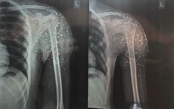 Wounded Iran Protesters Avoid Hospitalization In Fear Of Arrest