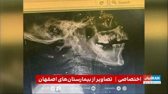 Hospital X-ray exclusively obtained by Iran International shows shot pellets lodged in the skull of a protester.