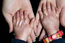 روزنامه شرق: قطعی آب و برق بیماران پروانهای را در خطر قطع عضو قرار داده است