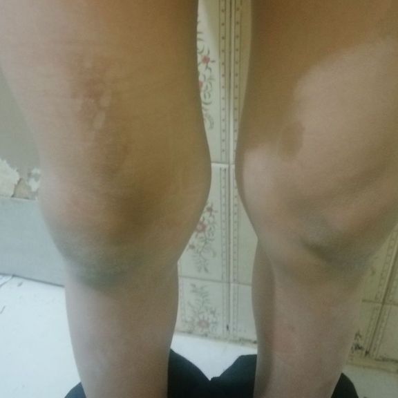 The kid who was burned by clothing-iron (undated)