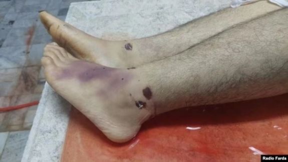 This photo shows the injuries and bruises on Peyman Galvani's legs. (July 2023)