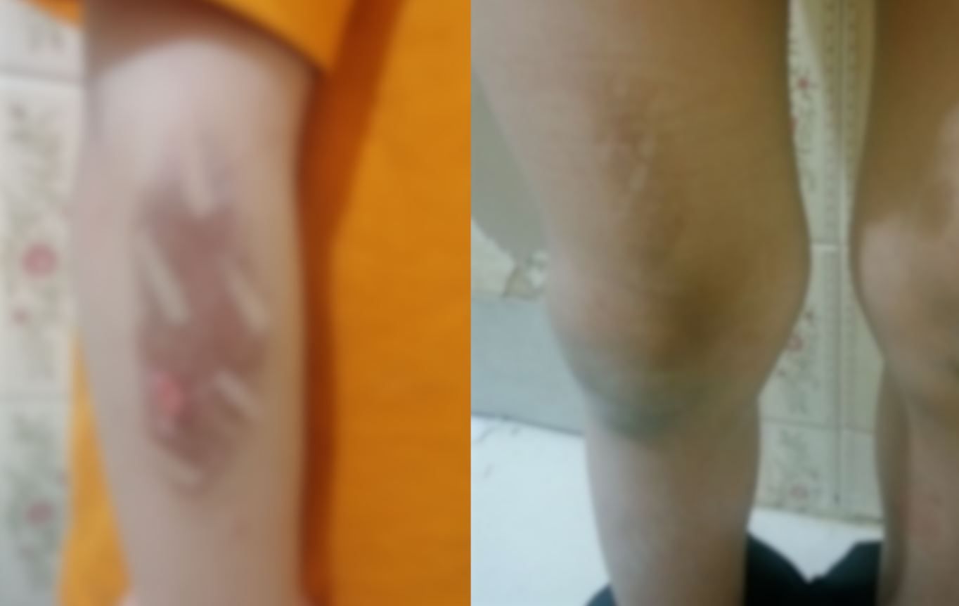 گزارش روزنامه اعتماد؛ به‌علت شب ادراری، دست و پای یک کودک را در مرکز نگهداری سوزاندند