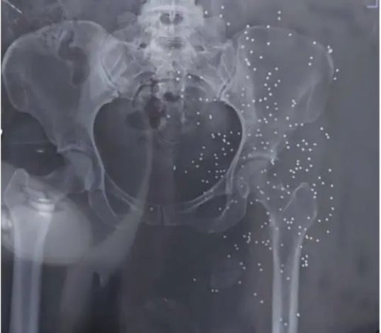 An x-ray image showing the genitals of a protester targeted by shotgun.
