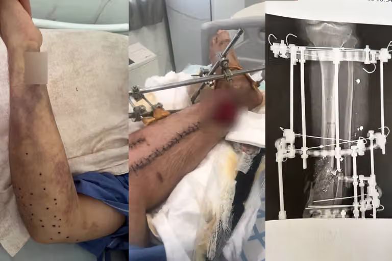 An injured Iranian protester’s leg during treatment following a gunshot wound. The protester told Iran International he has undergone 23 surgeries and remains unable to walk.