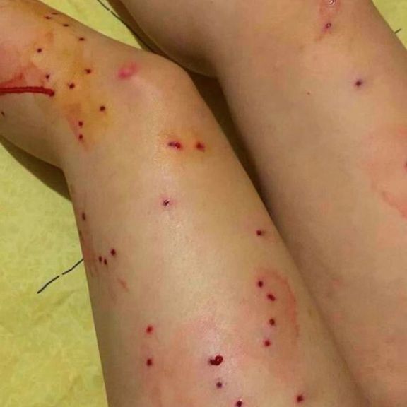 A woman protester injured by 'birdshots' from a shotgun during protests
