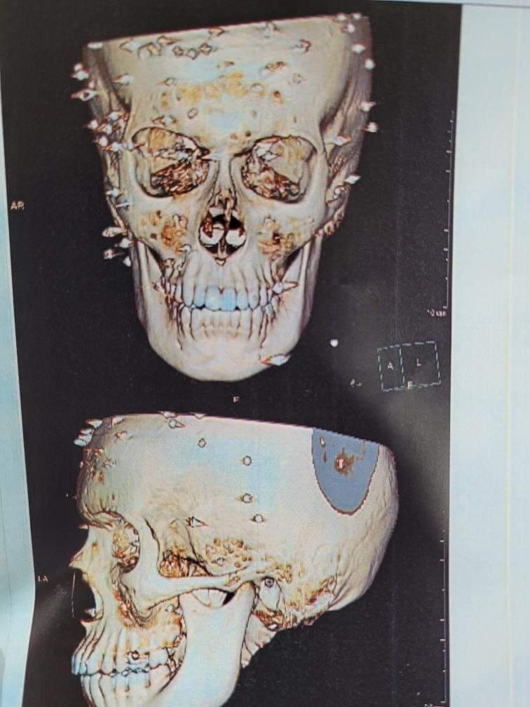 An MRI image showing the pellets in the head of a protester  (March 2023)