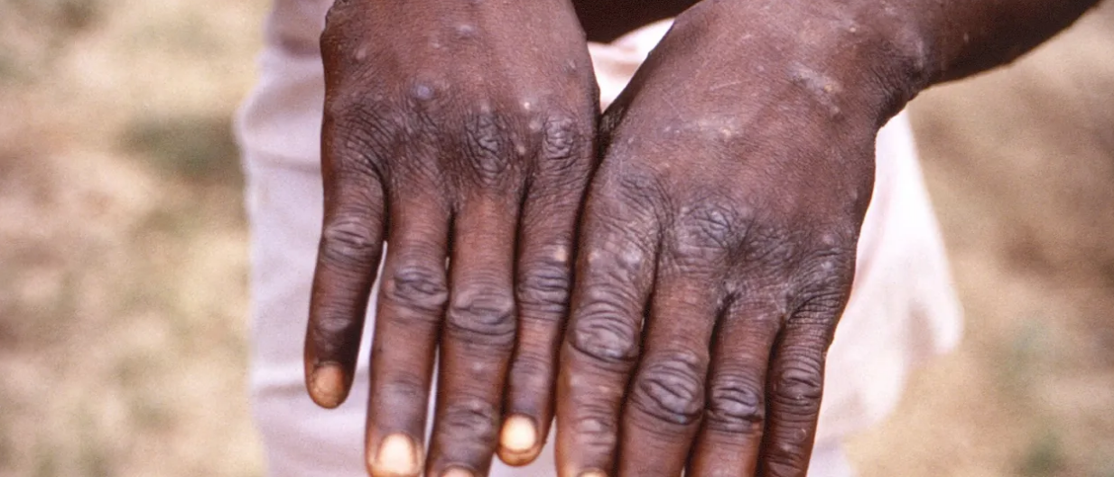 سازمان بهداشت جهانی شیوع آبله میمون را «وضعیت اضطراری جهانی» اعلام کرد