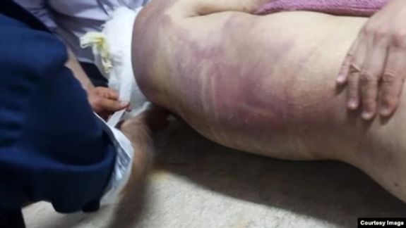 This photo shows the injuries and bruises on Peyman Galvani's back. (July 2023)