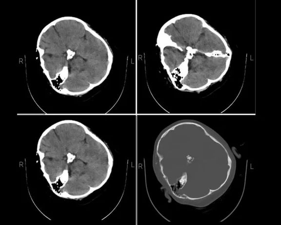 Mahsa Amini's brain CT scan obtained by Iran International