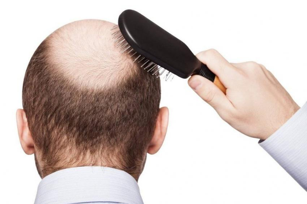 آنچه درباره کمبود اسید معده نمیدانید؛ از مشکلات گوارشی تا ریزش مو