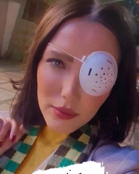 معترضی که با گلوله چشمش را از دست داد؛ یکی ازم پرسید ارزشش رو داشت؟ گفتم آره، شدیدا