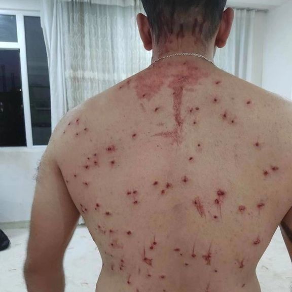 A protester hit with 'birdshots' - small shotgun pellets that can injure eyes or even kill