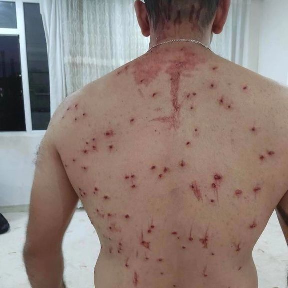 An Iranian man injured by a 'bird shot' fired from a shotgun In September 2022