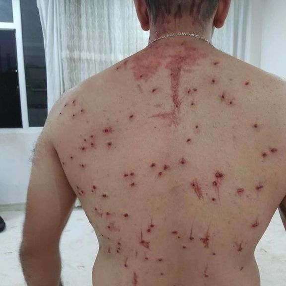 A man targeted by a shotgun 'bird shot' shell in Iran in September, frequently used by security forces