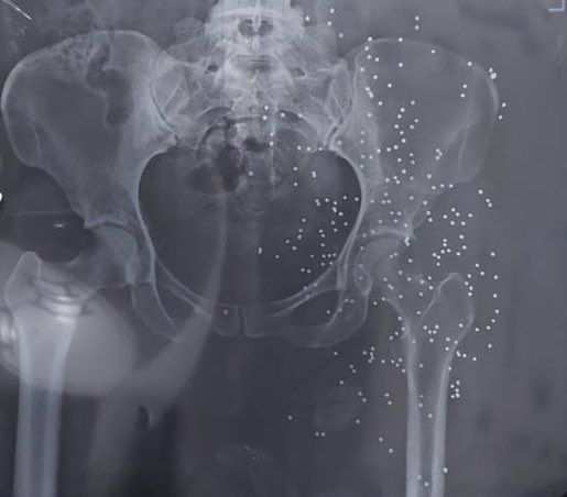 An x-ray image showing the genitals of a protester targeted by shotgun (March 2023)