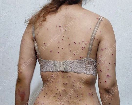 A woman targeted with shotgun 'birdshots' during protests in Iran