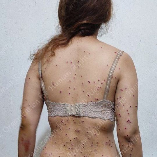 A woman who was shot during protests by 'birdshots' fired from a police shotgun