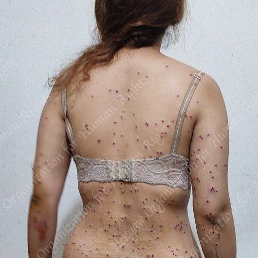 A woman shot in Tehran in October with shotgun pellets