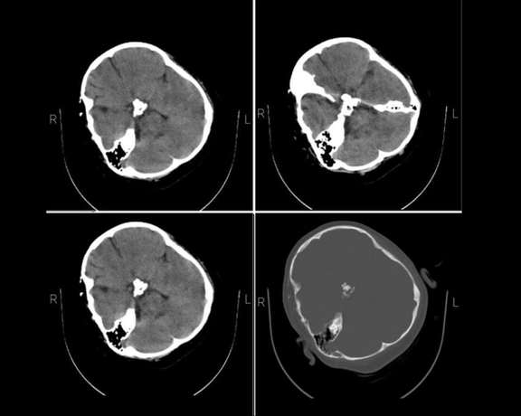 The skull CT scan of Mahsa Amini
