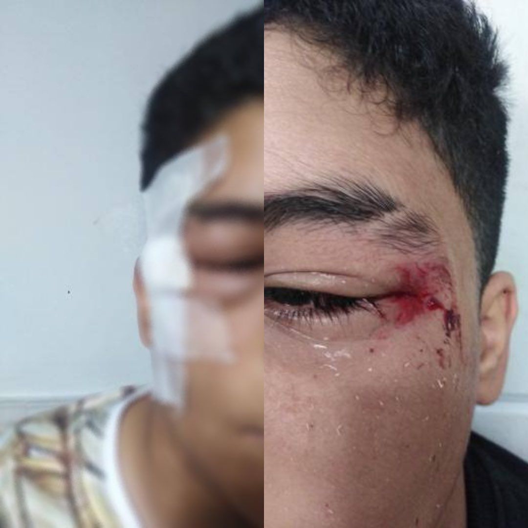 An Iranian protester injured in the eye during protests (November 2022)