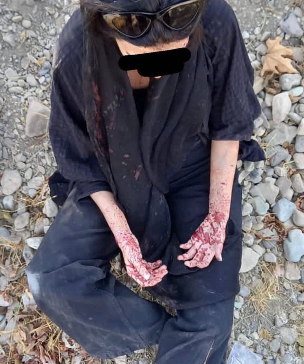 A protester hit in the hands by shotgun  